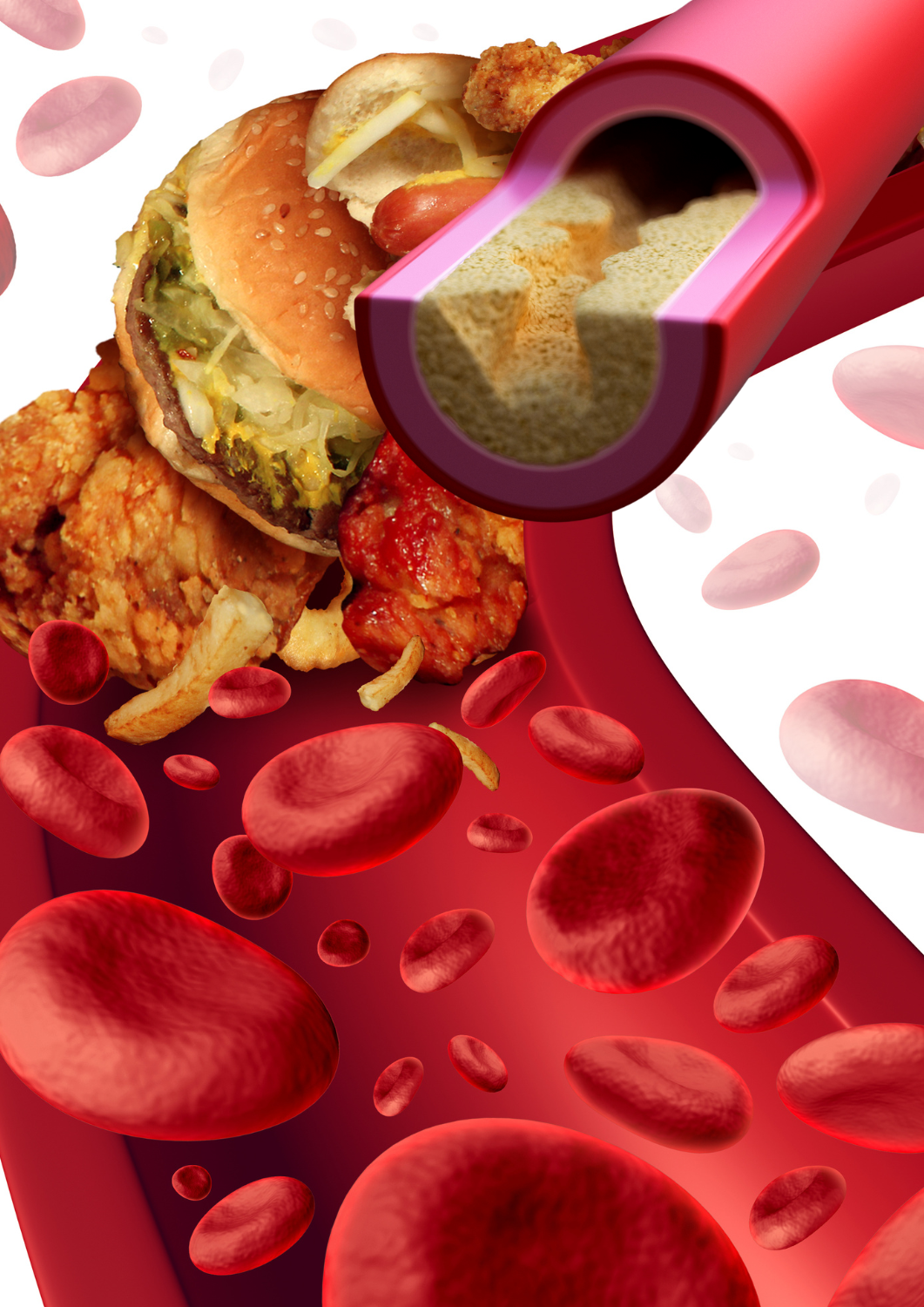 Diet Affecting Our Arteries